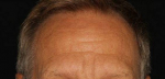 Forehead Lines After